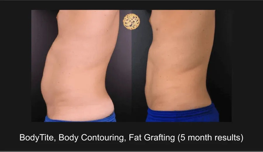 Male Body Contouring Before & After