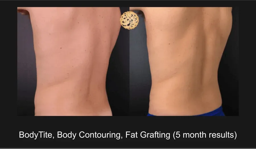 Male Body Contouring Before & After