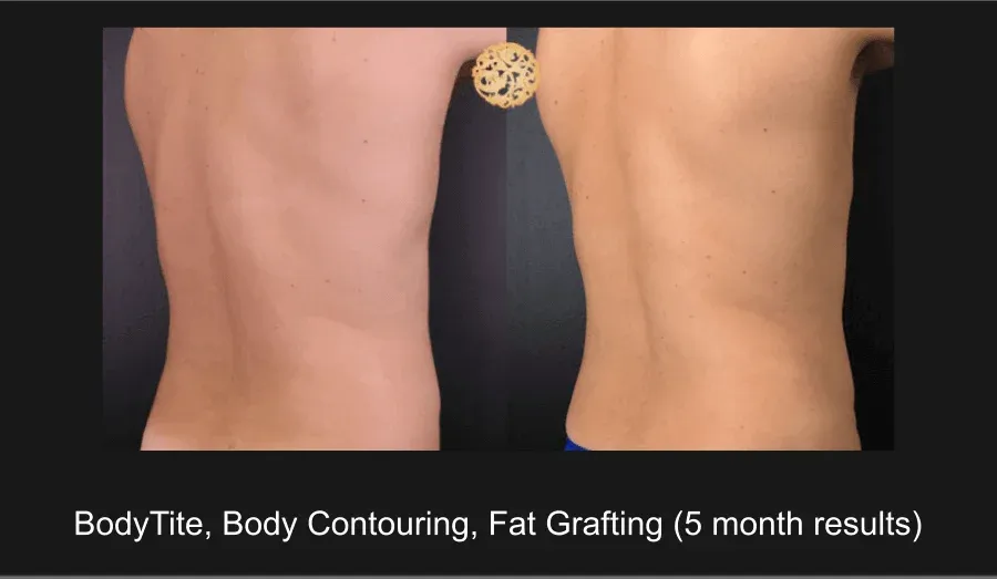 Male Body Contouring Before & After