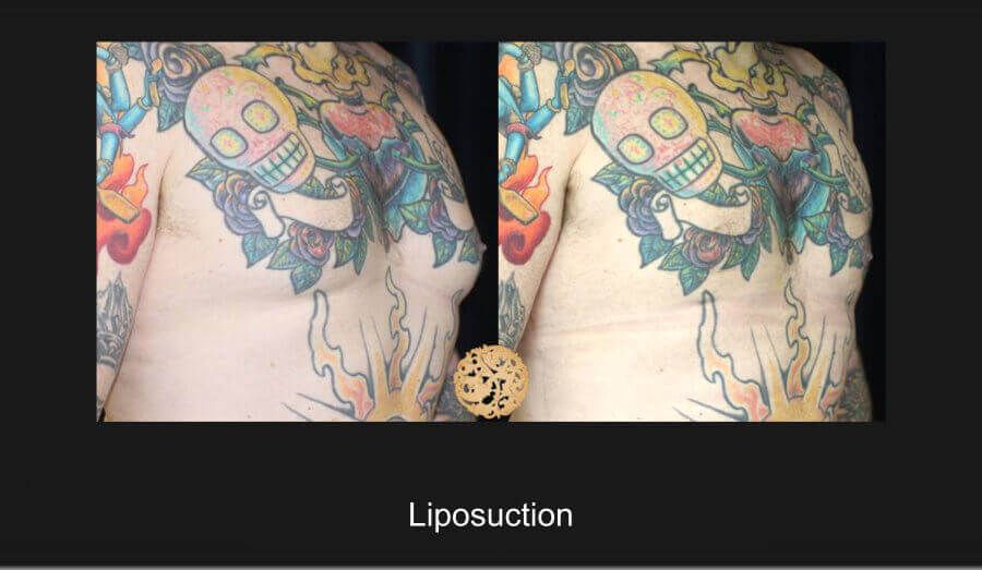 Male Body Contouring Before & After