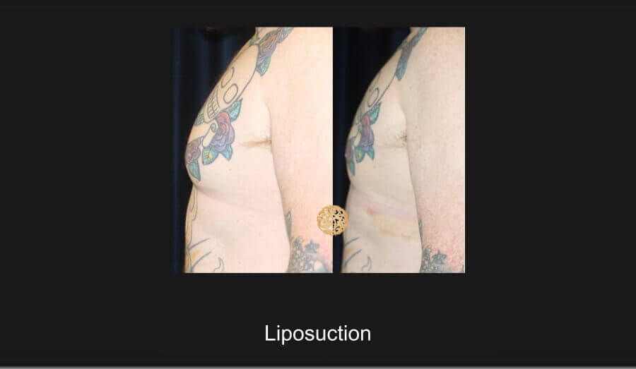 Male Body Contouring Before & After