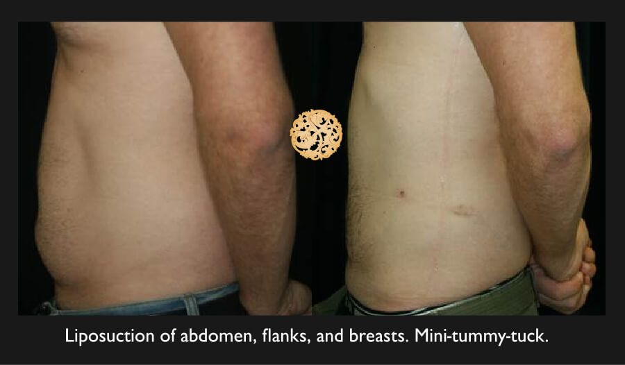 Male Body Contouring Before & After