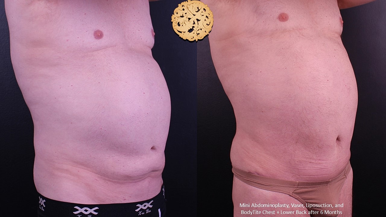 Male Body Contouring Before & After