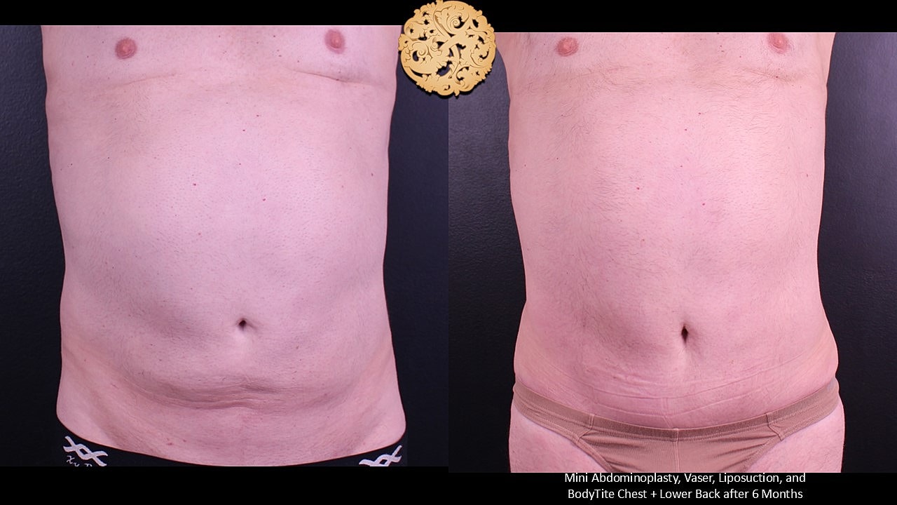 Male Body Contouring Before & After