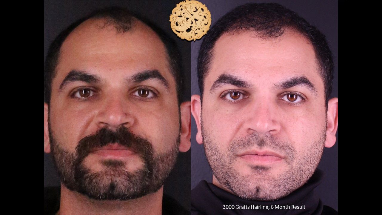 Hair Transplant Before & After
