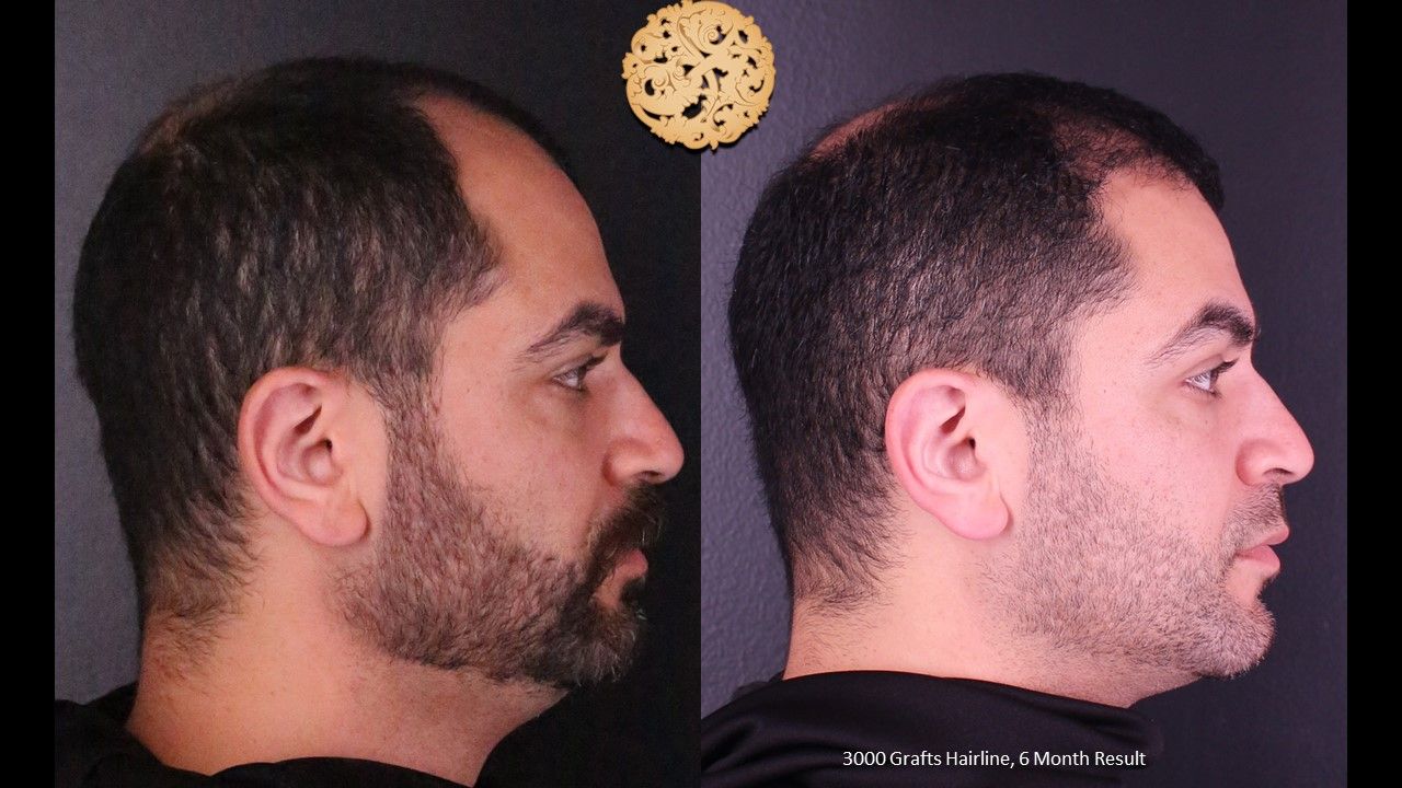 Hair Transplant Before & After