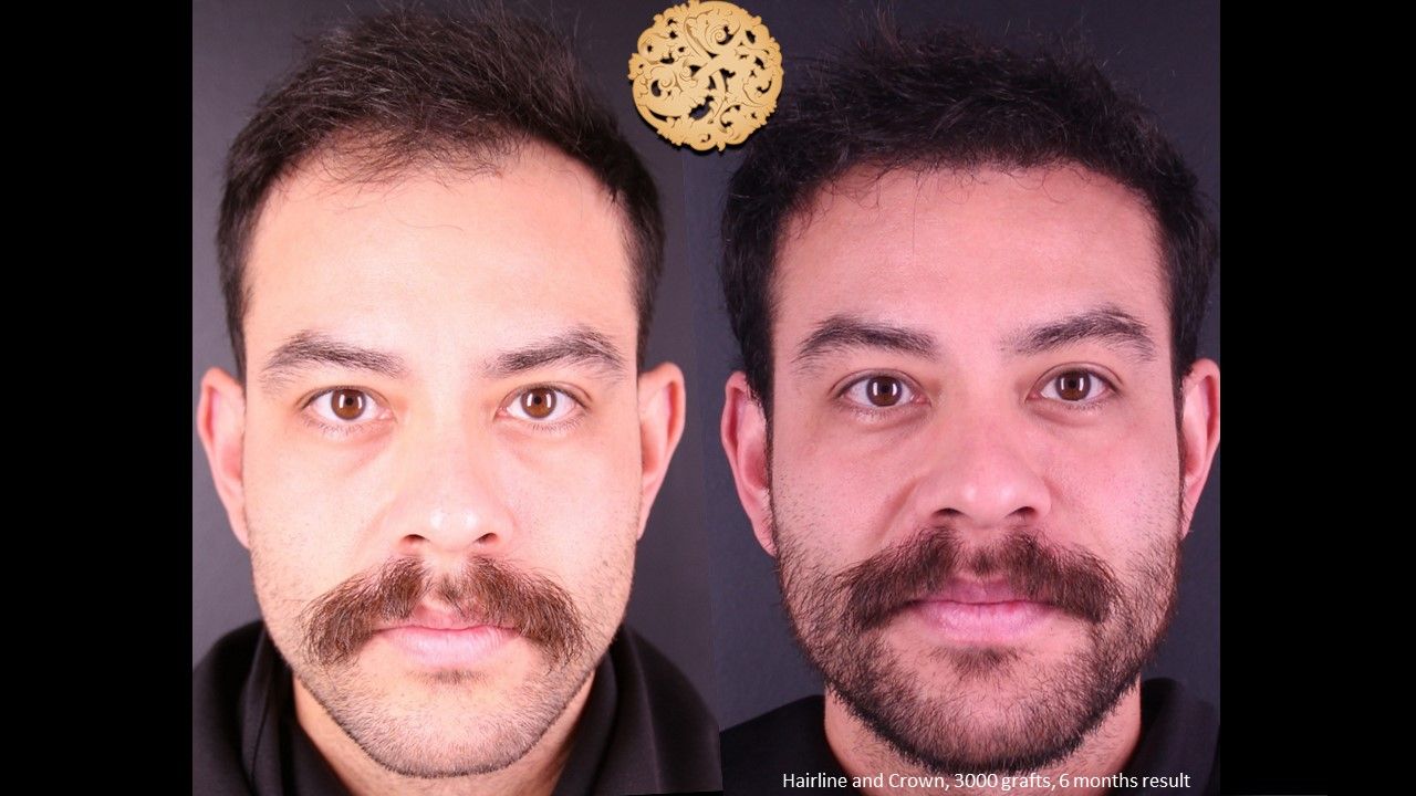 Hair Transplant Before & After