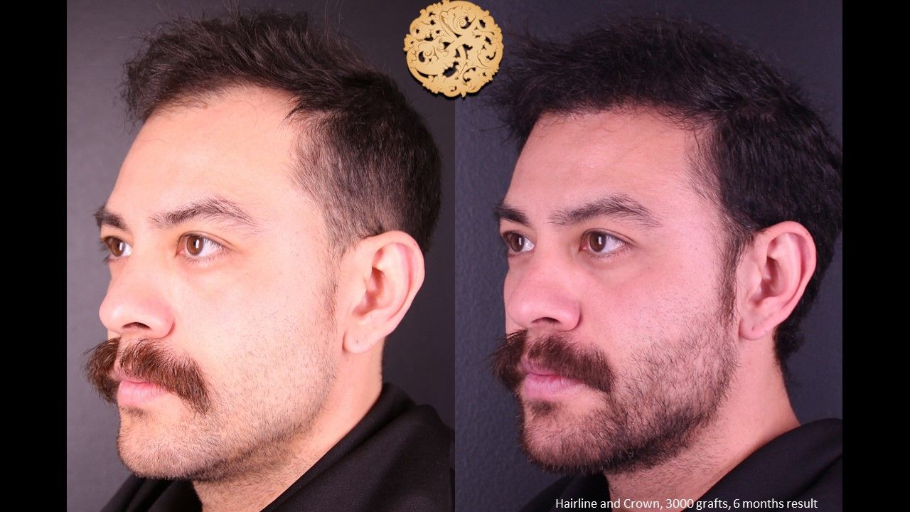 Hair Transplant Before & After