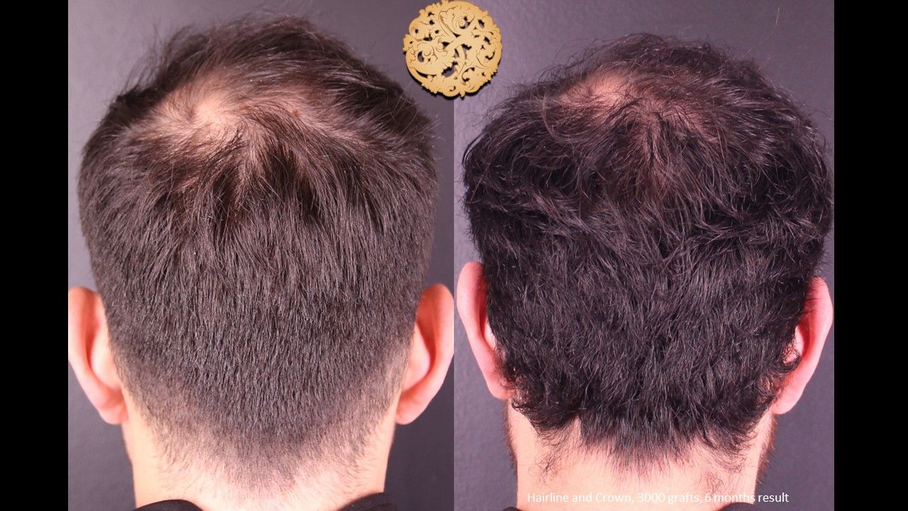 Hair Transplant Before & After