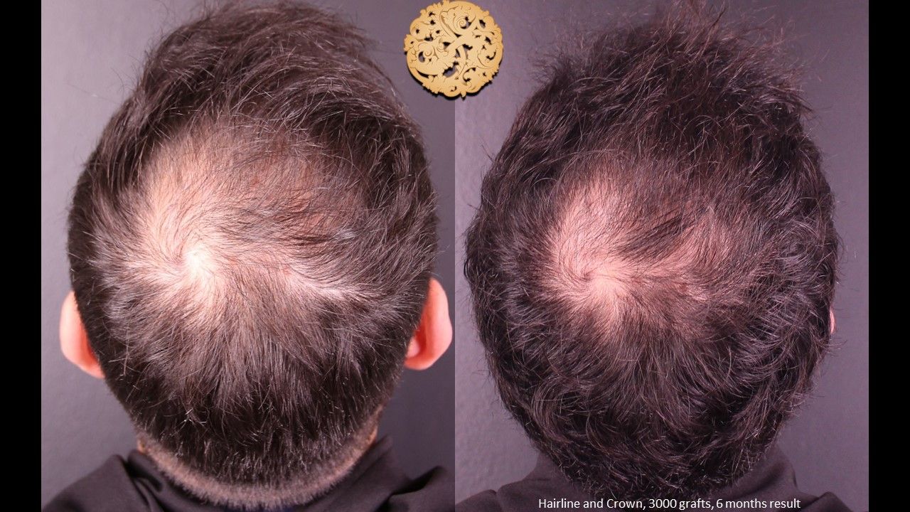 Hair Transplant Before & After
