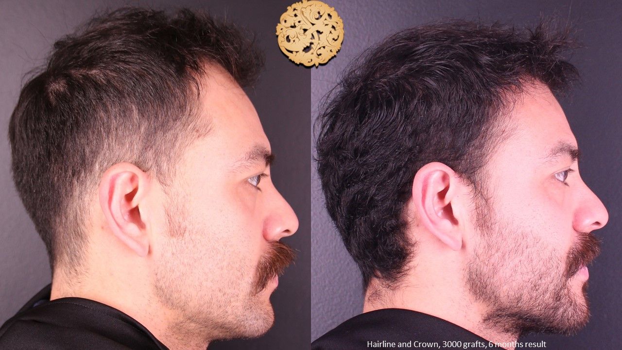 Hair Transplant Before & After