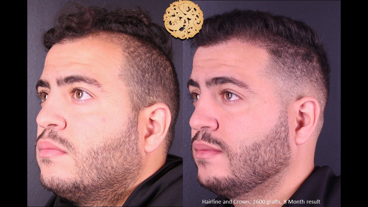 Hair Transplant Before & After