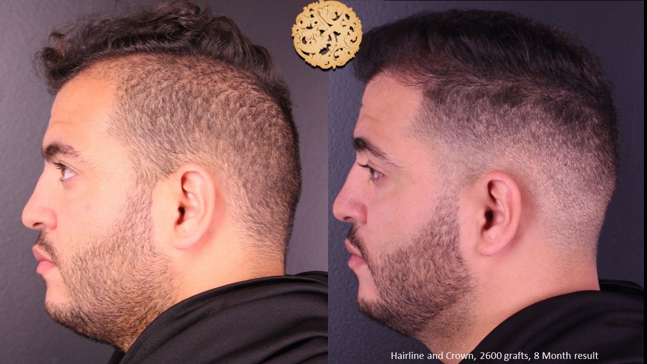 Hair Transplant Before & After