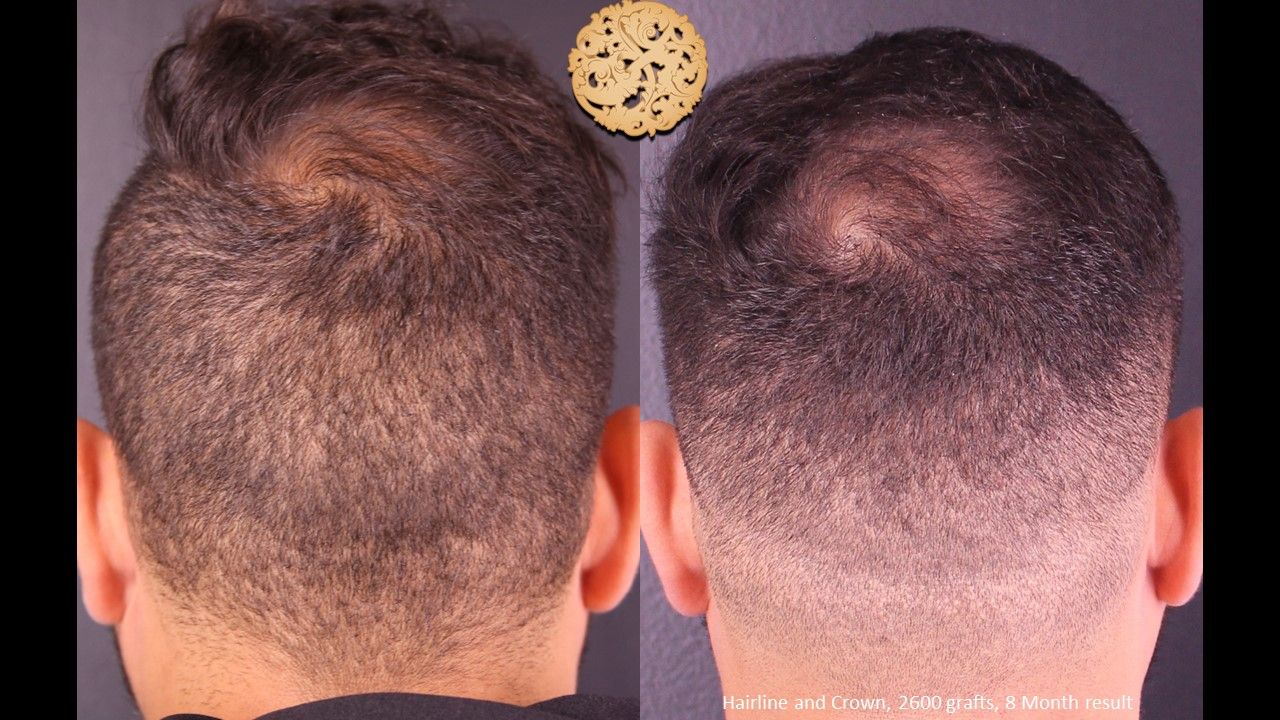 Hair Transplant Before & After