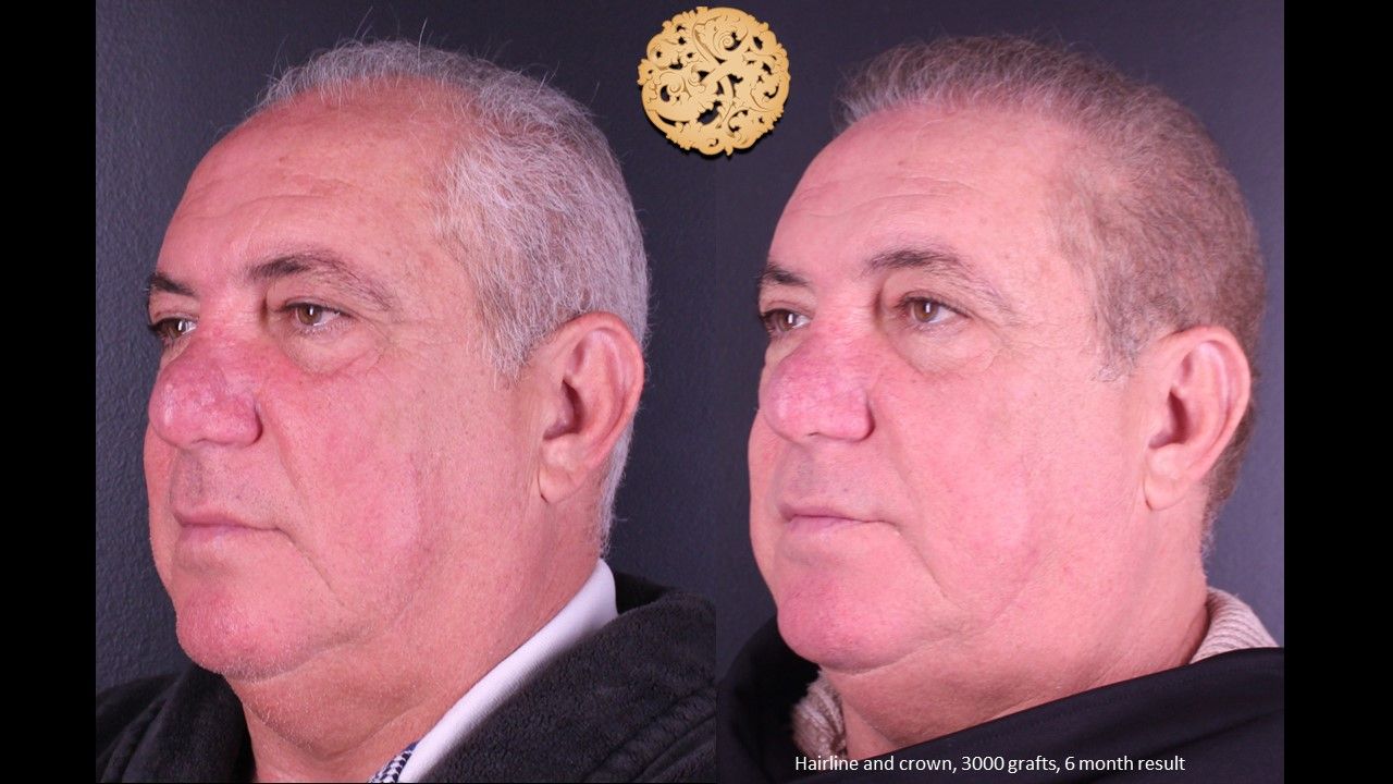 Hair Transplant Before & After