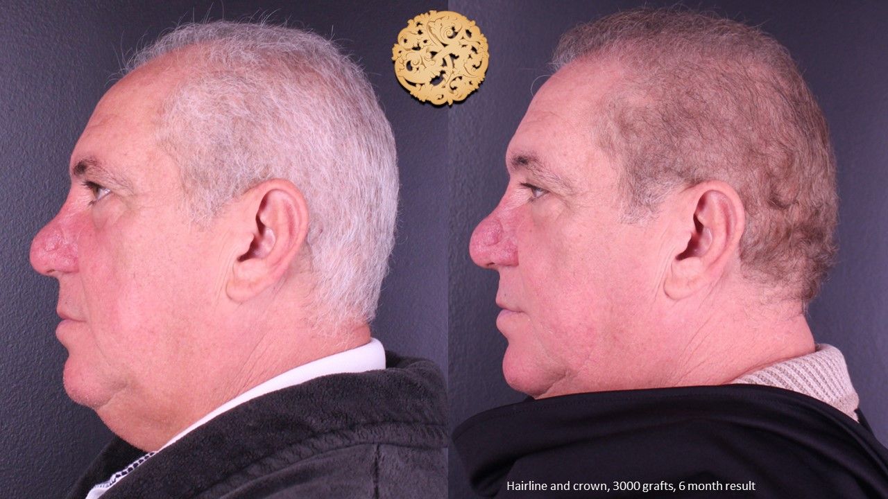 Hair Transplant Before & After