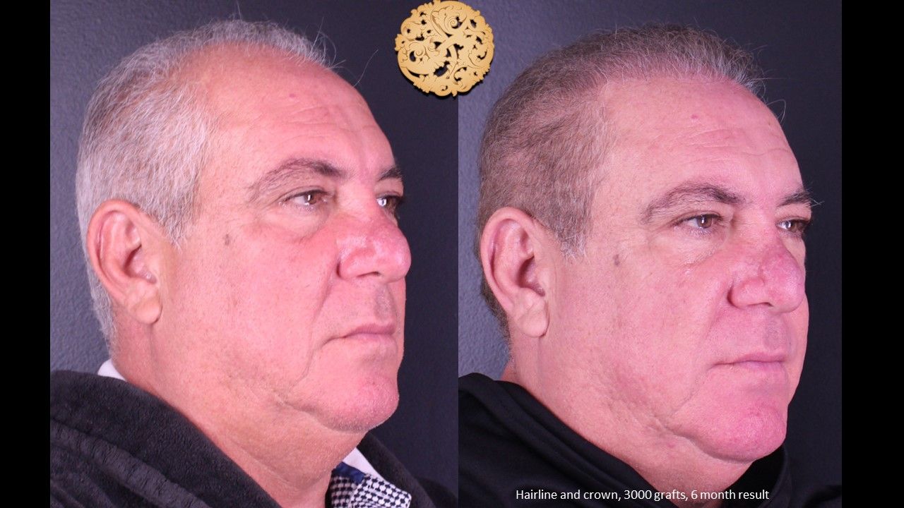 Hair Transplant Before & After