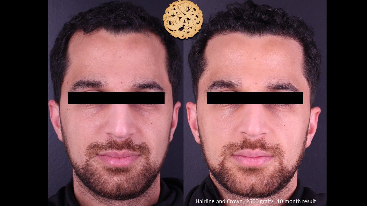 Hair Transplant Before & After