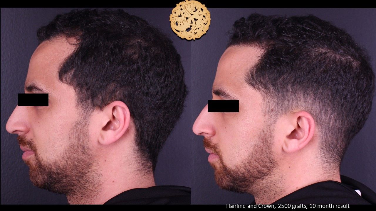 Hair Transplant Before & After