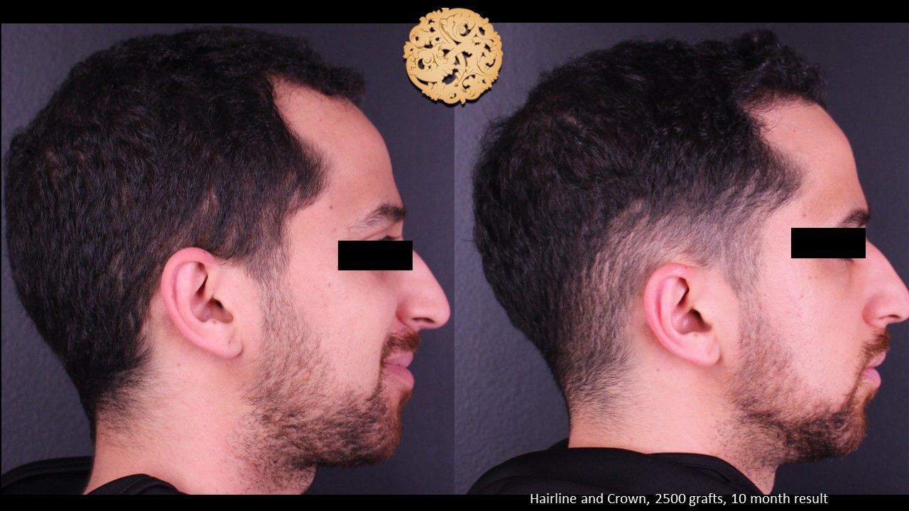Hair Transplant Before & After