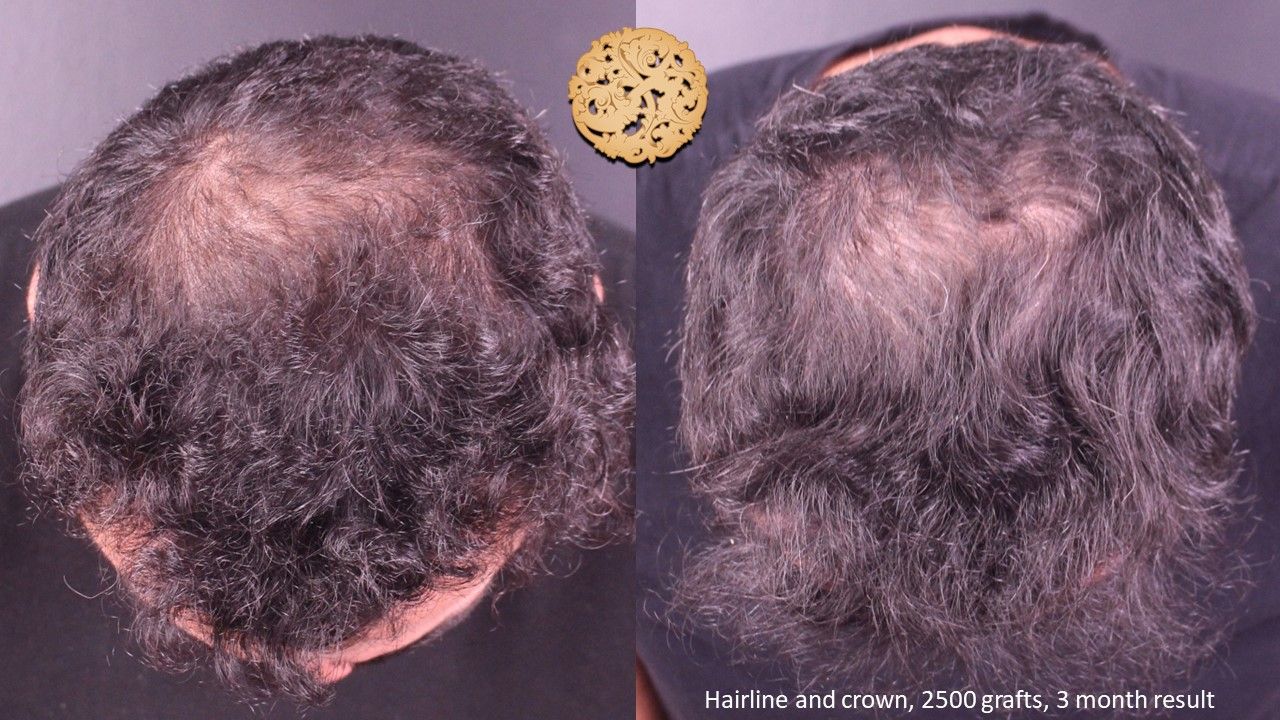 Hair Transplant Before & After