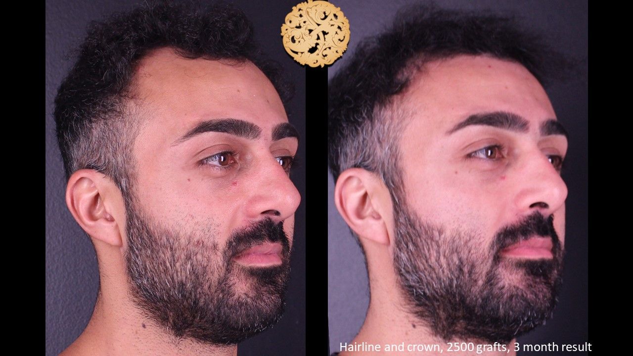 Hair Transplant Before & After