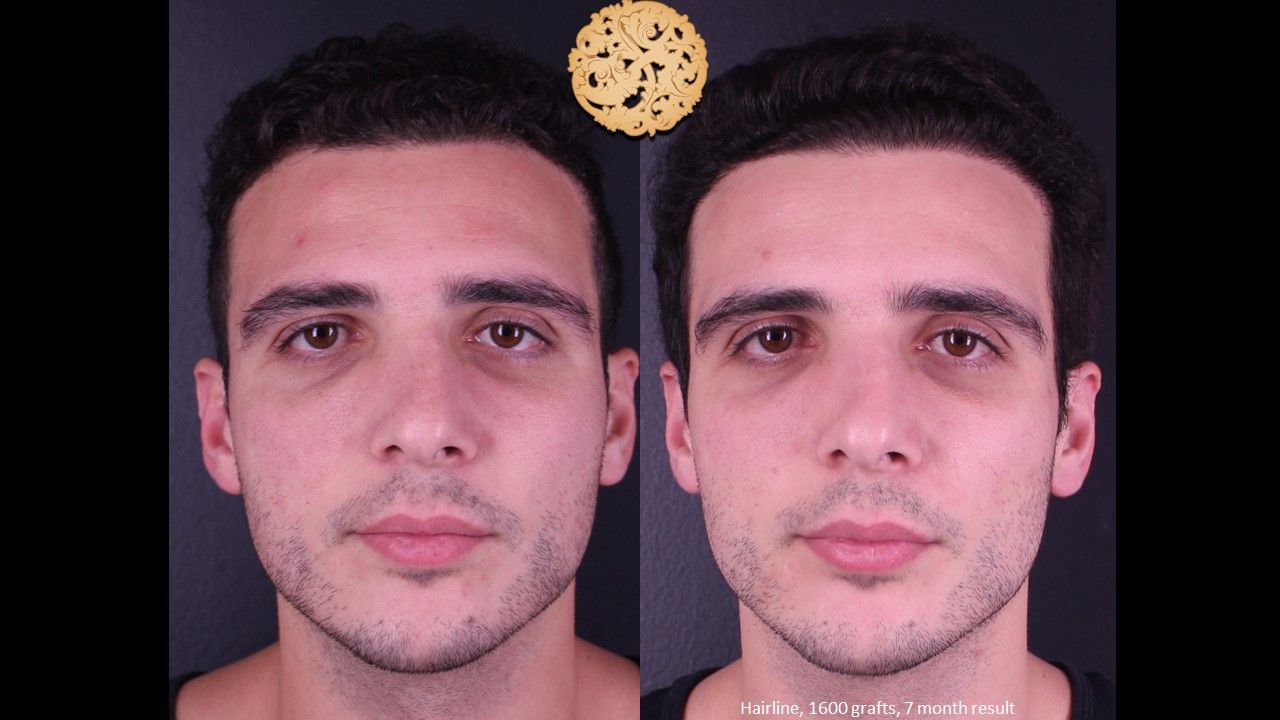 Hair Transplant Before & After