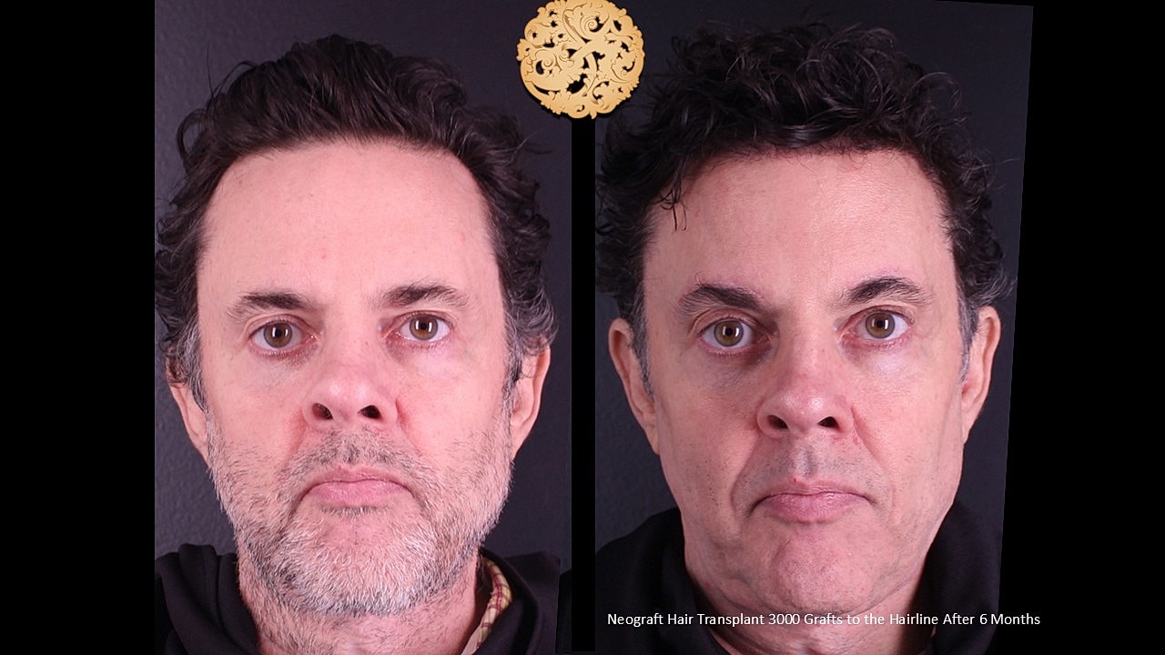 Hair Transplant Before & After