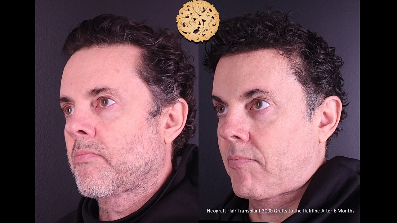 Hair Transplant Before & After