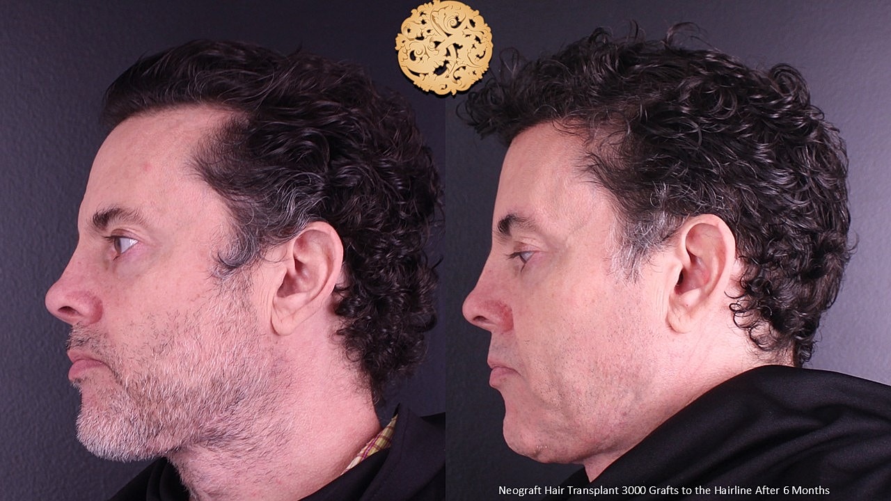 Hair Transplant Before & After