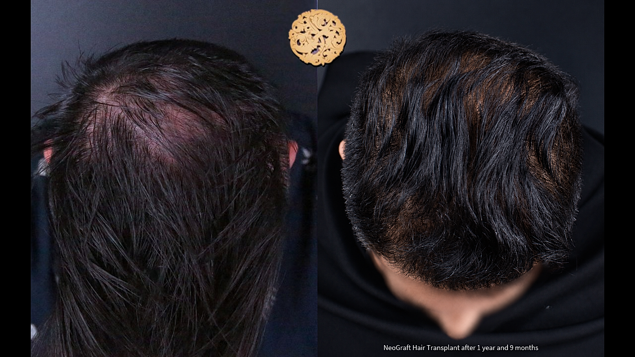 Hair Transplant Before & After