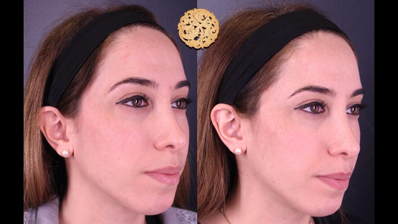 Cheek Filler Before & After