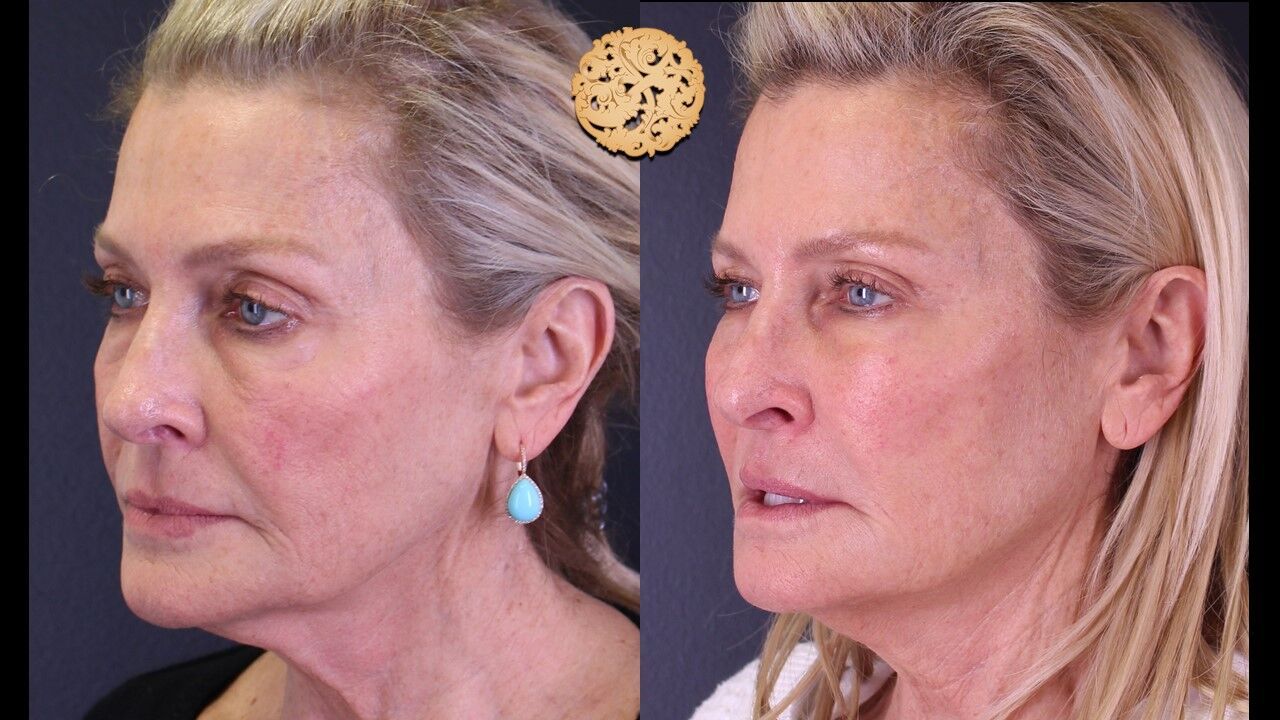 Cheek Filler Before & After