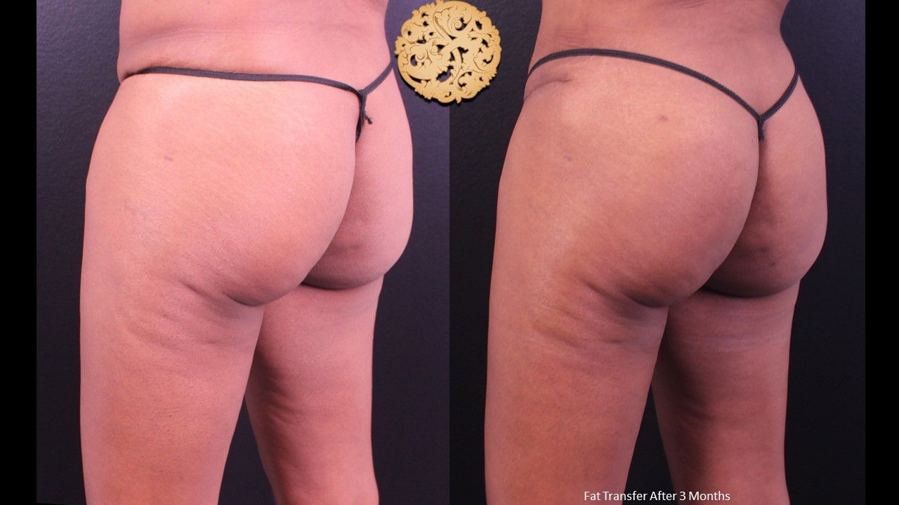 Fat Transfer Buttocks Before & After
