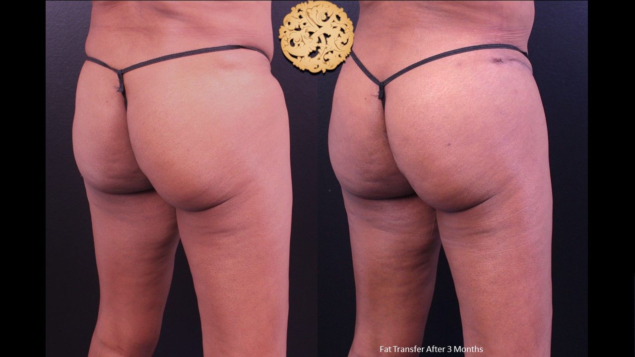 Fat Transfer Buttocks Before & After