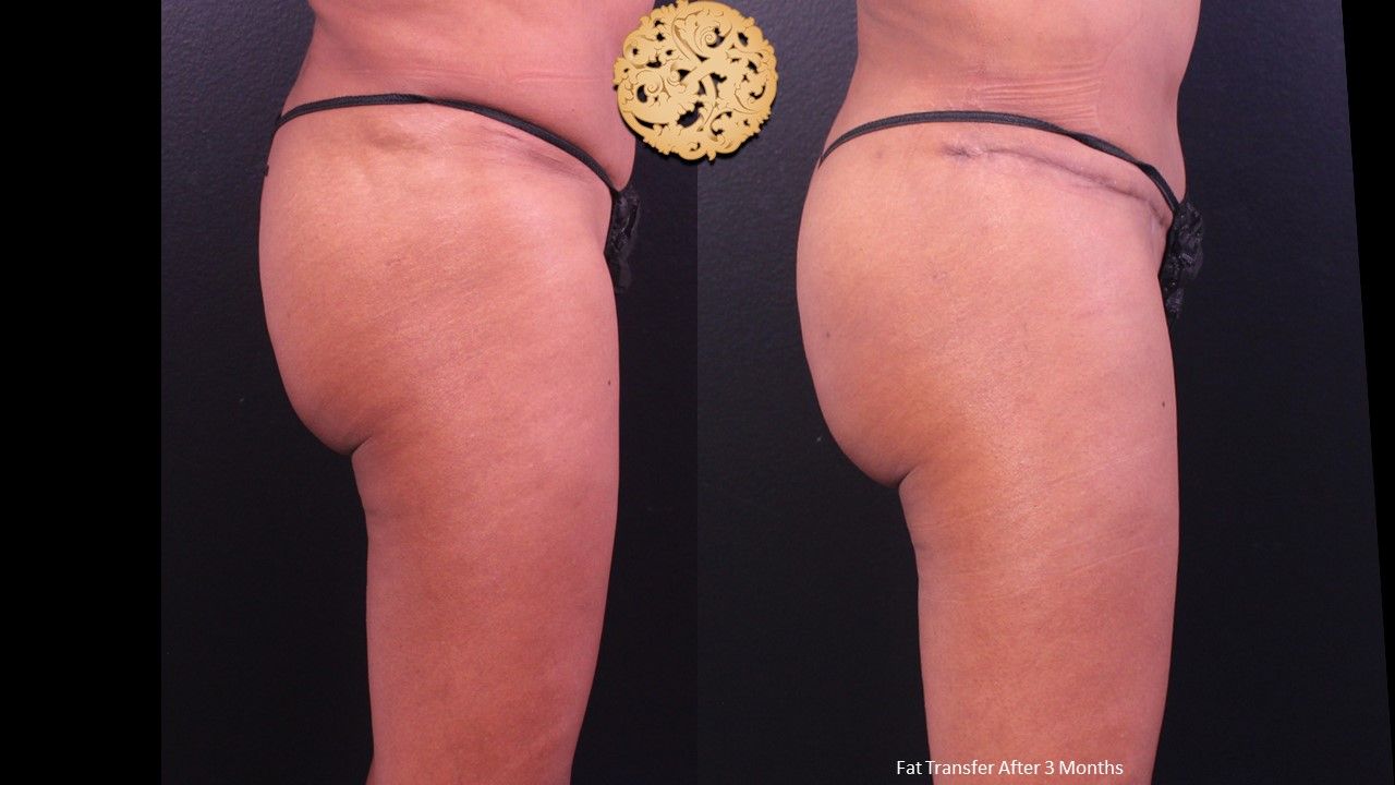 Fat Transfer Buttocks Before & After