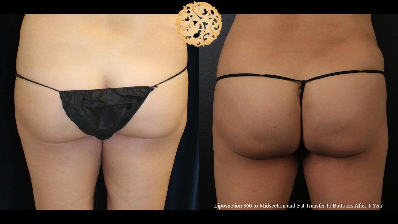 Fat Transfer Buttocks Before & After