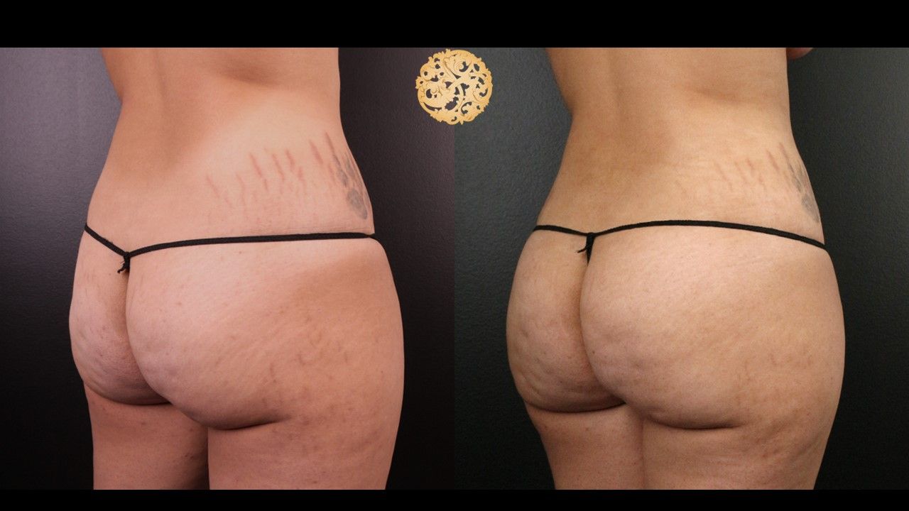 Fat Transfer Buttocks Before & After
