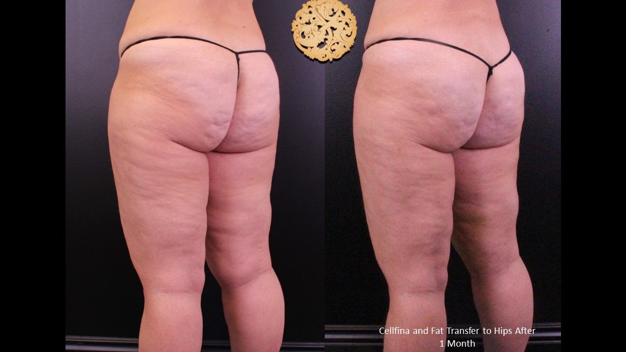 Fat Transfer Buttocks Before & After