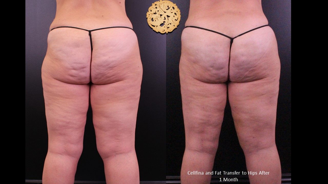 Fat Transfer Buttocks Before & After