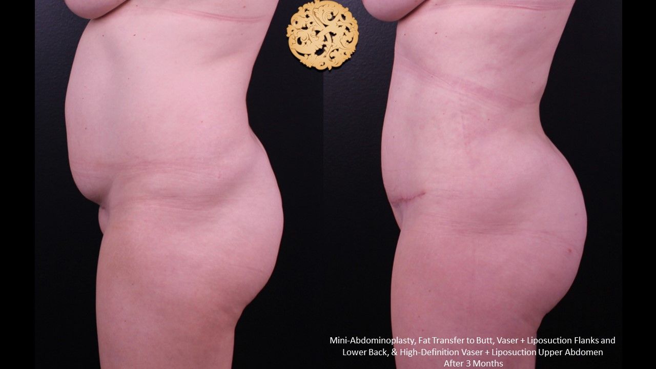 Fat Transfer Buttocks Before & After