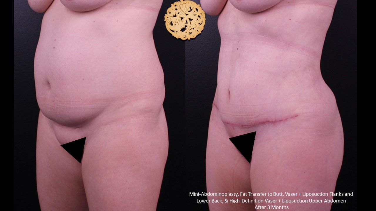 Fat Transfer Buttocks Before & After