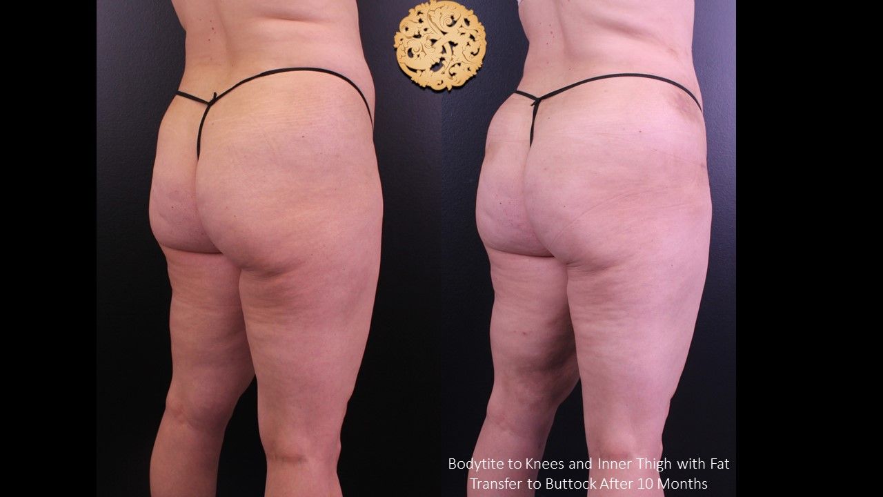 Fat Transfer Buttocks Before & After