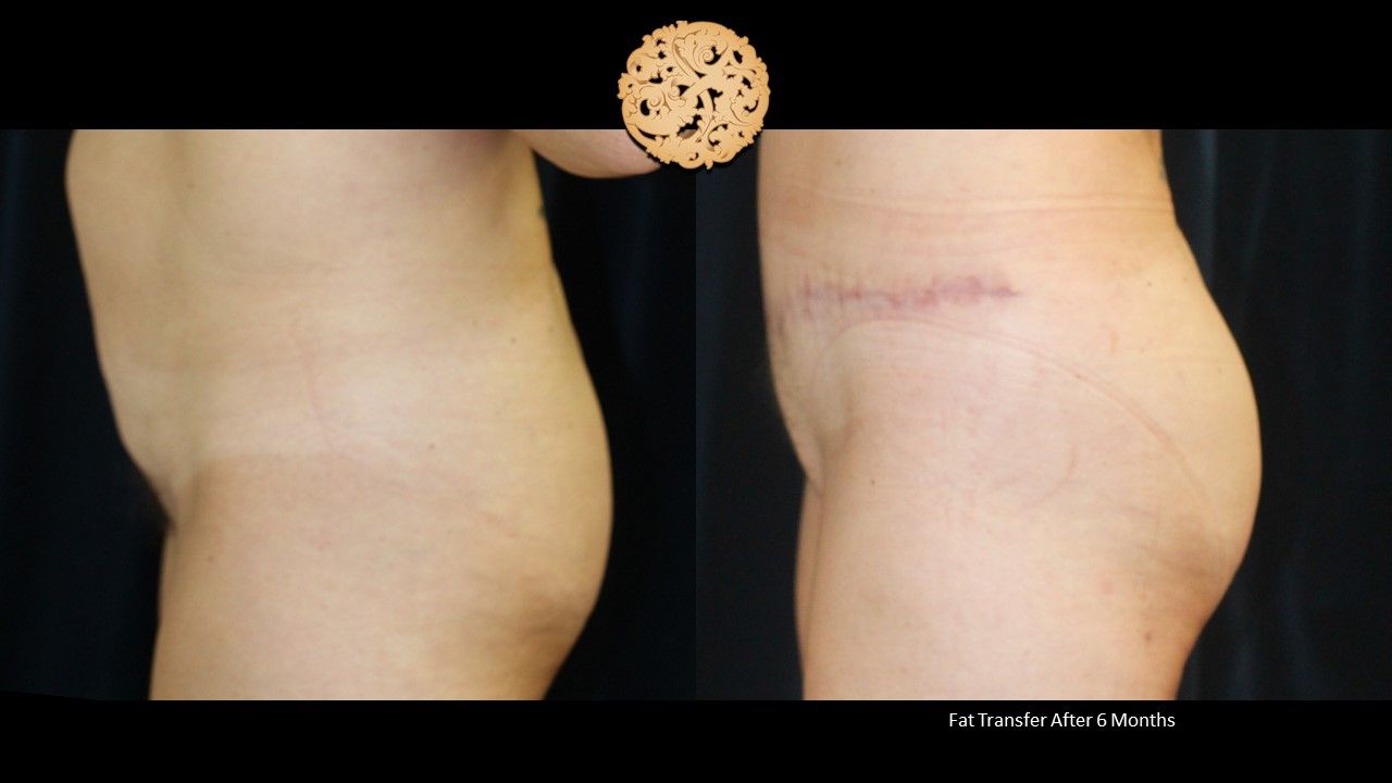 Fat Transfer Buttocks Before & After