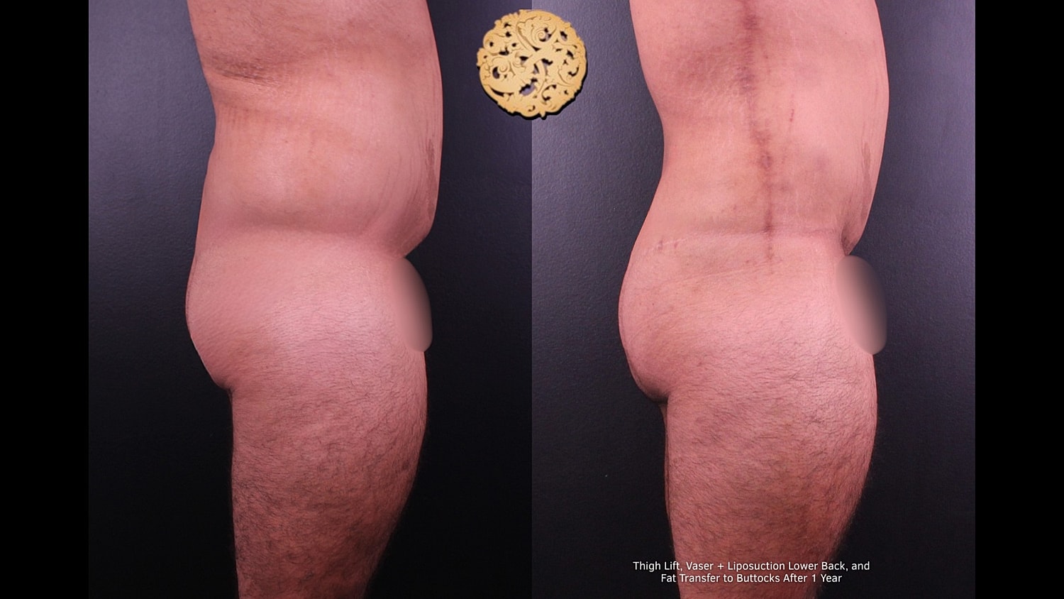 Fat Transfer Buttocks Before & After