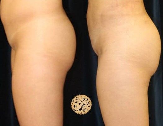 Fat Transfer Buttocks Before & After