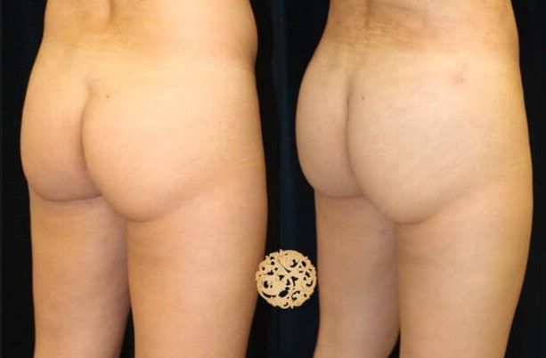 Fat Transfer Buttocks Before & After