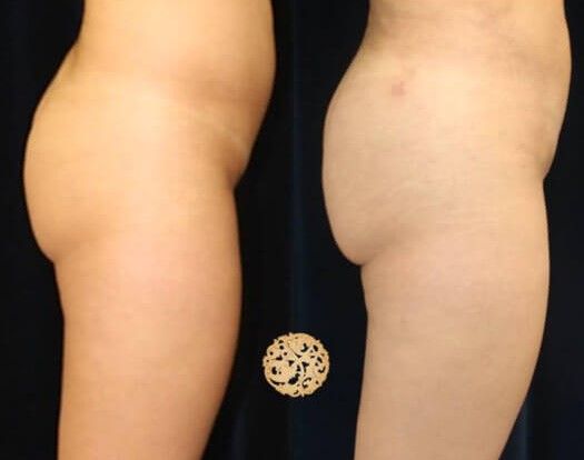 Fat Transfer Buttocks Before & After