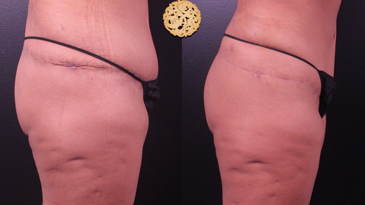 Fat Transfer Buttocks Before & After