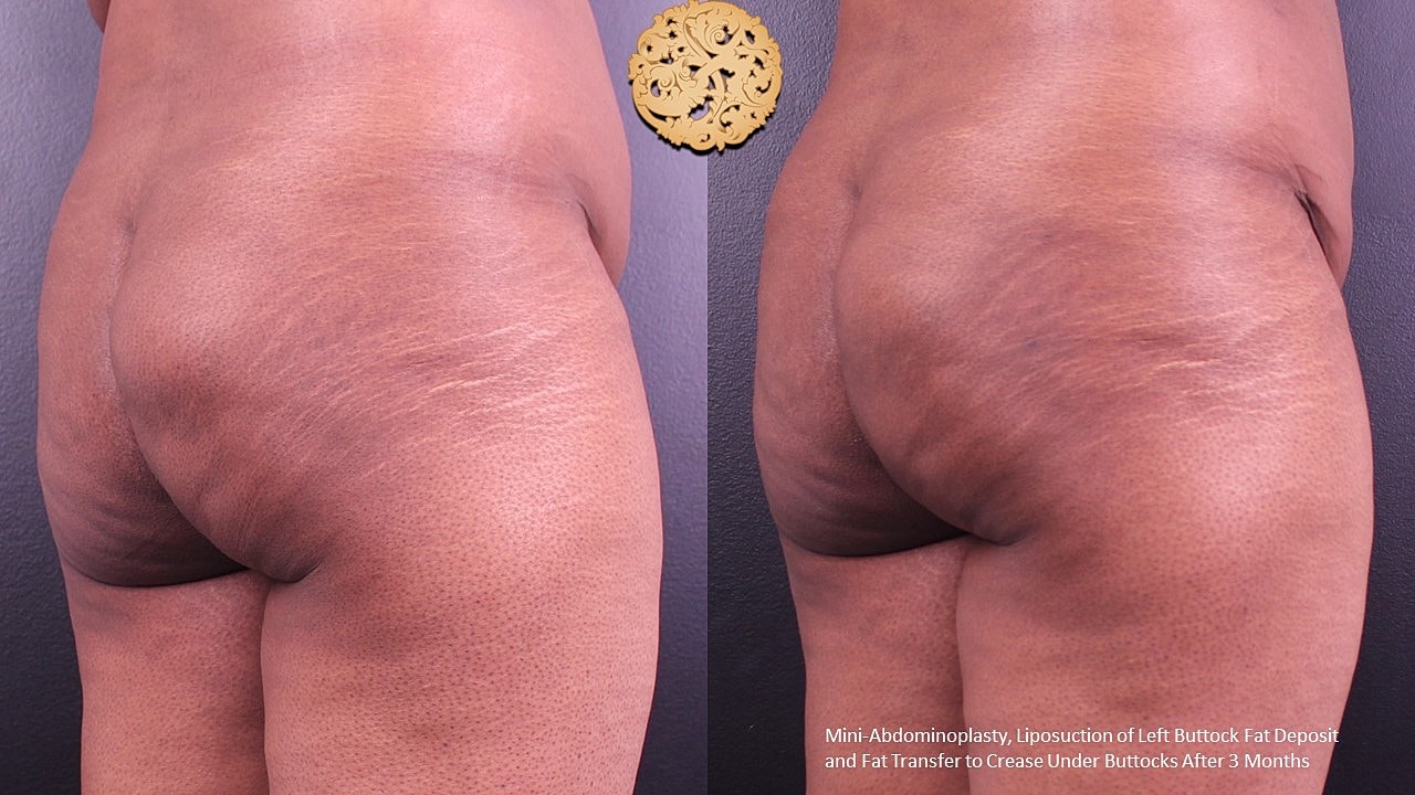 Fat Transfer Buttocks Before & After
